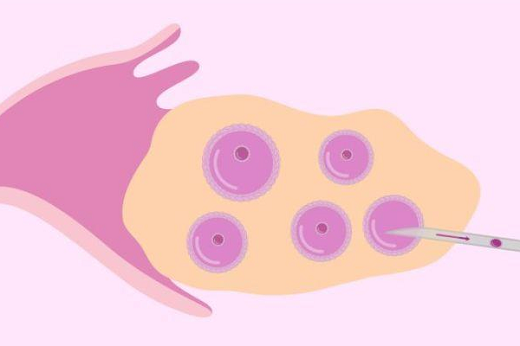 试管婴儿性别筛选方法是什么